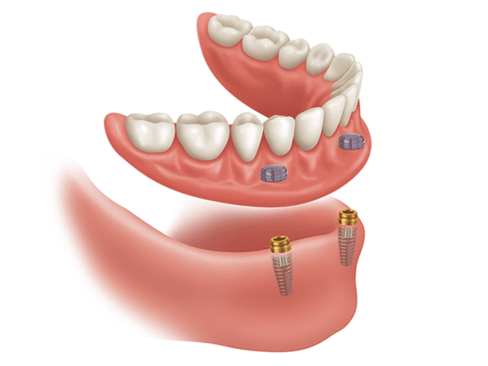 LOCATOR® Implant Attachment System